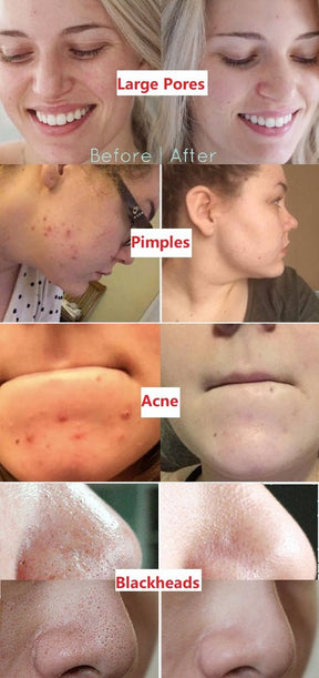 🌿 Máscara em bastão de argila com chá verde natural Serenya™ – Limpa acne e refina os poros