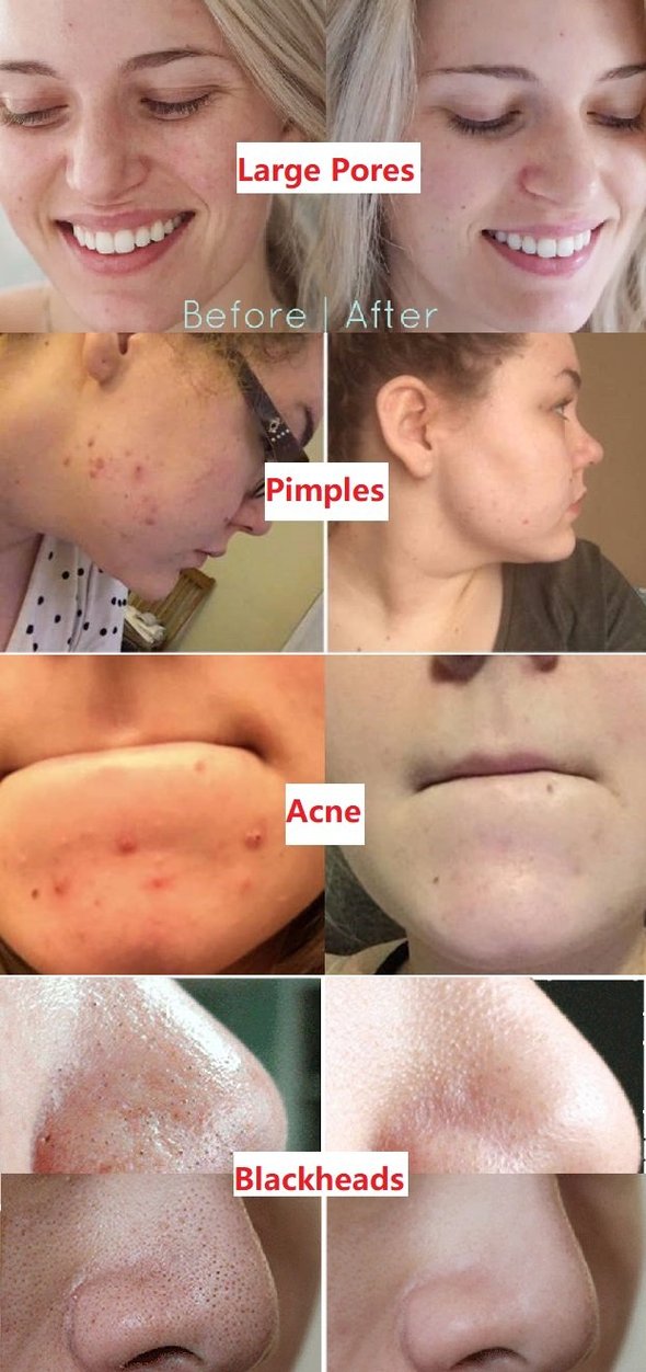 🌿 Máscara em bastão de argila com chá verde natural Serenya™ – Limpa acne e refina os poros