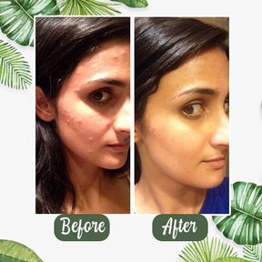 🌿 Máscara em bastão de argila com chá verde natural Serenya™ – Limpa acne e refina os poros